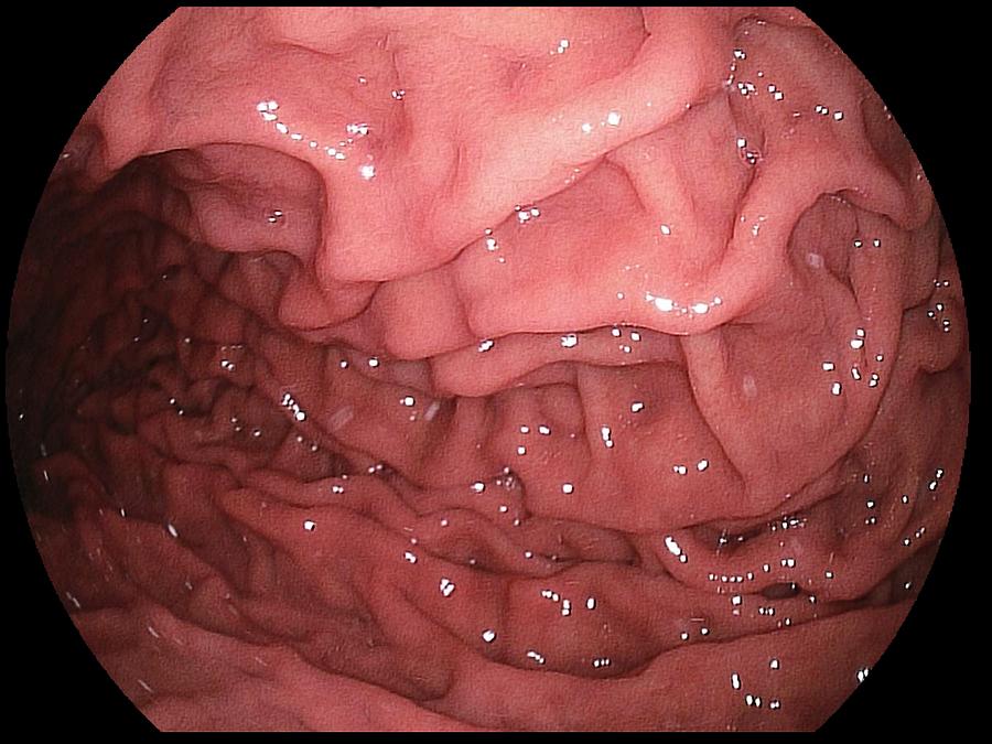 Endoscopy Photograph - Healthy Stomach #1 by Gastrolab