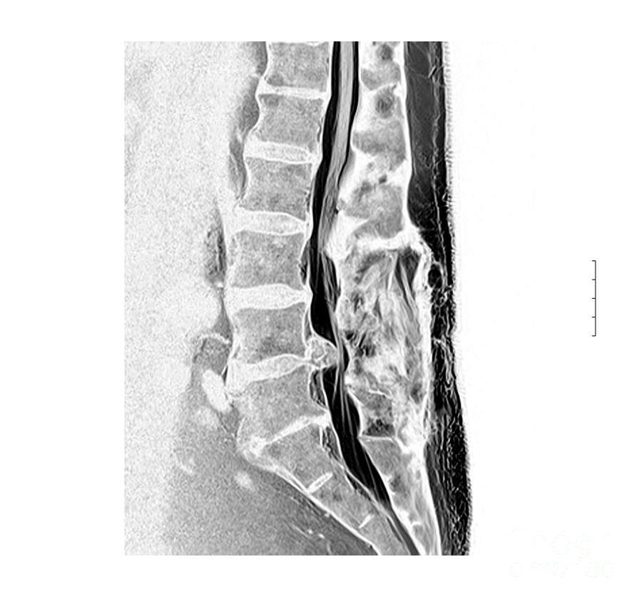 Sagittal Photograph - Herniated Disc #1 by Medical Body Scans