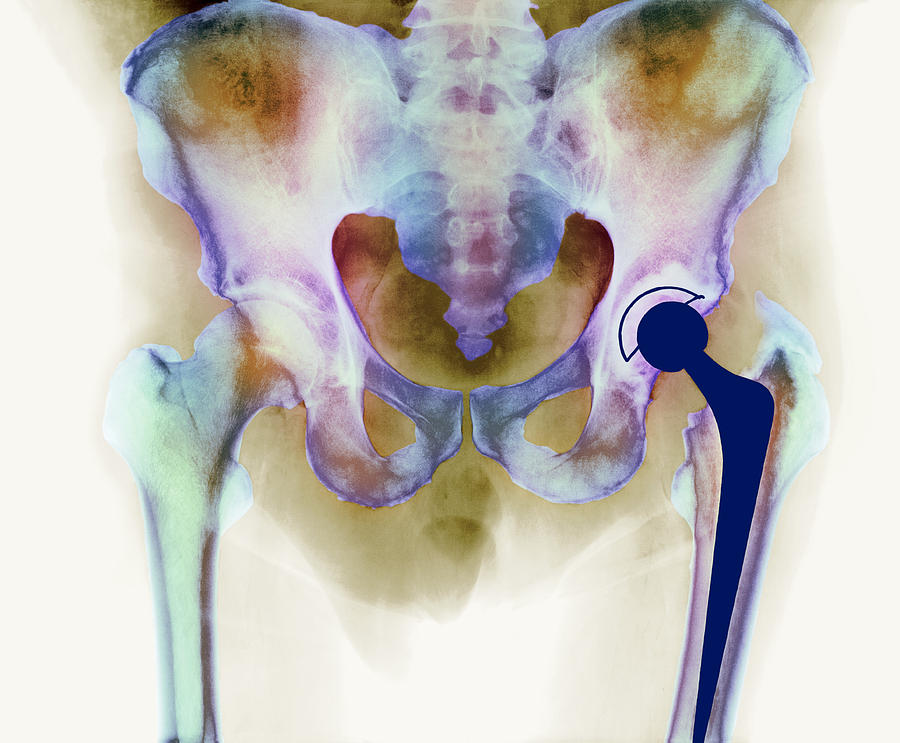 Hip Joint Replacement Photograph - Hip Joint Replacement, X-ray #1 by 