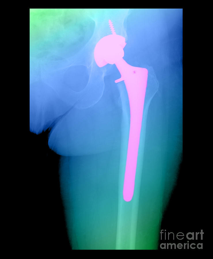 Hip Replacement #1 Photograph by Medical Body Scans