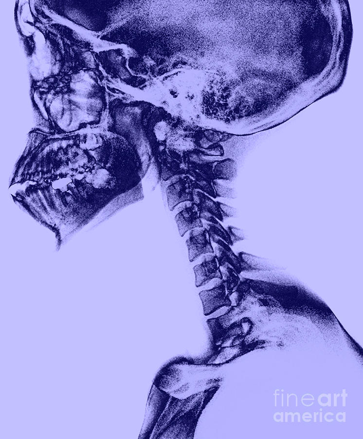 Human Skull And Spine #2 Photograph by Medical Body Scans