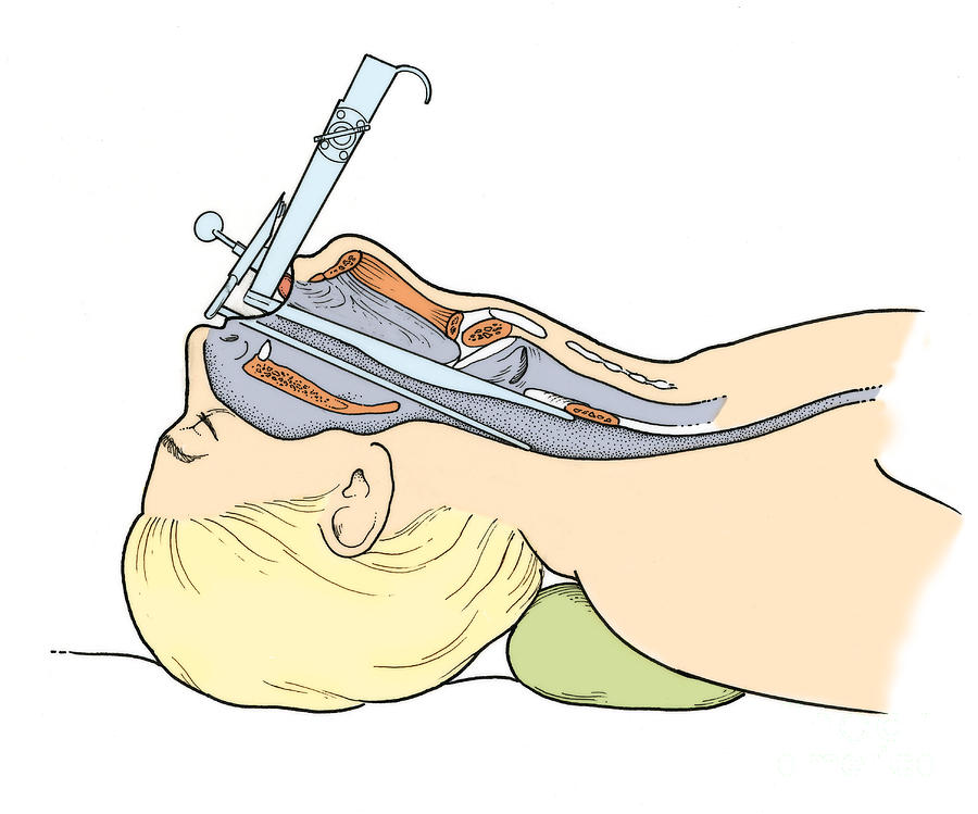 Illustration Of Laryngoscopy Photograph by Science Source Fine Art
