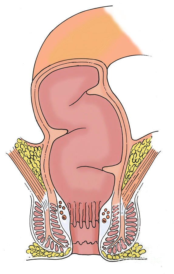 Illustration Of Rectum #1 Photograph by Science Source