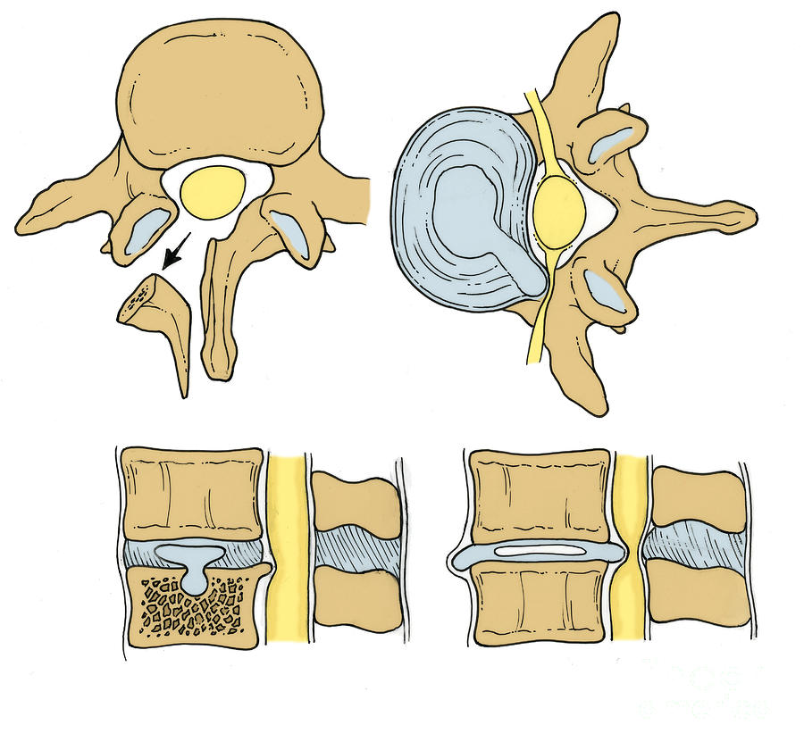 Illustration Of Spinal Disk Pathologies #1 Photograph by Science Source