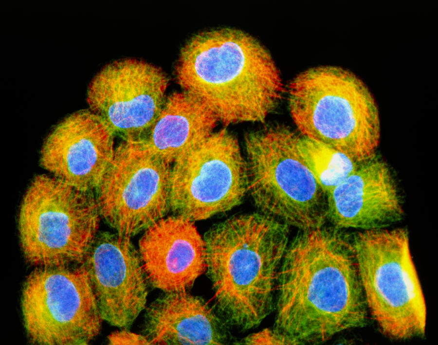 Images Photograph - Immunofluorescent Lm Of Squamous Carcinoma Cells #1 by Nancy Kedershaimmunogen