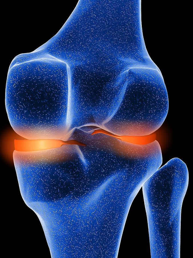 Inflamed Knee Cartilage, Computer Artwork Photograph By Pasieka - Fine 