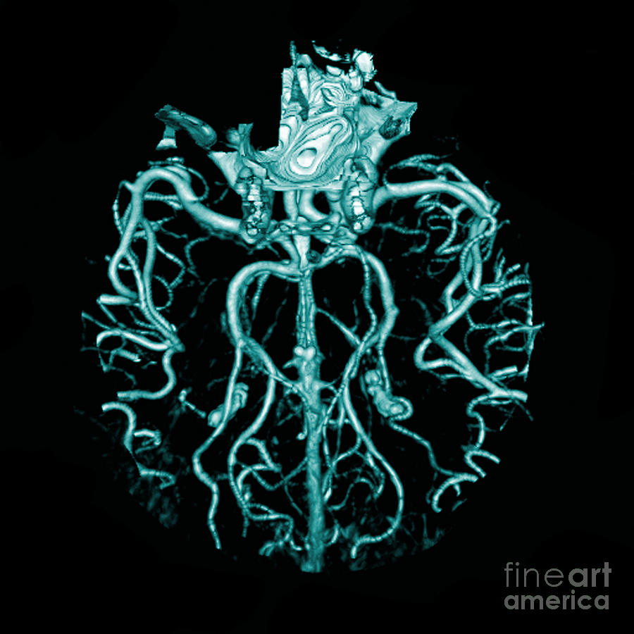 Intracranial Ct Angiogram #1 Photograph by Medical Body Scans