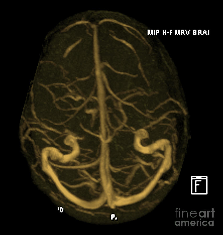 Intracranial Magnetic Resonance Venogram #1 Photograph by Medical Body Scans