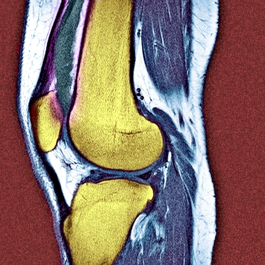 fluid in knee