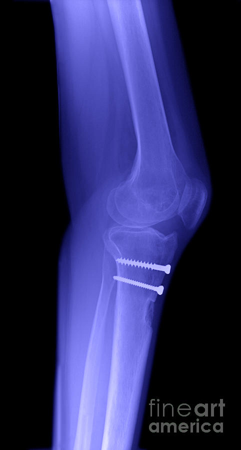 Knee Joint #1  by Ted Kinsman