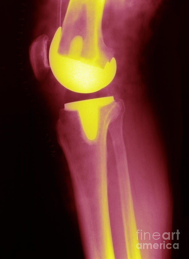 Knee Replacement X-ray #1 Photograph by Ted Kinsman
