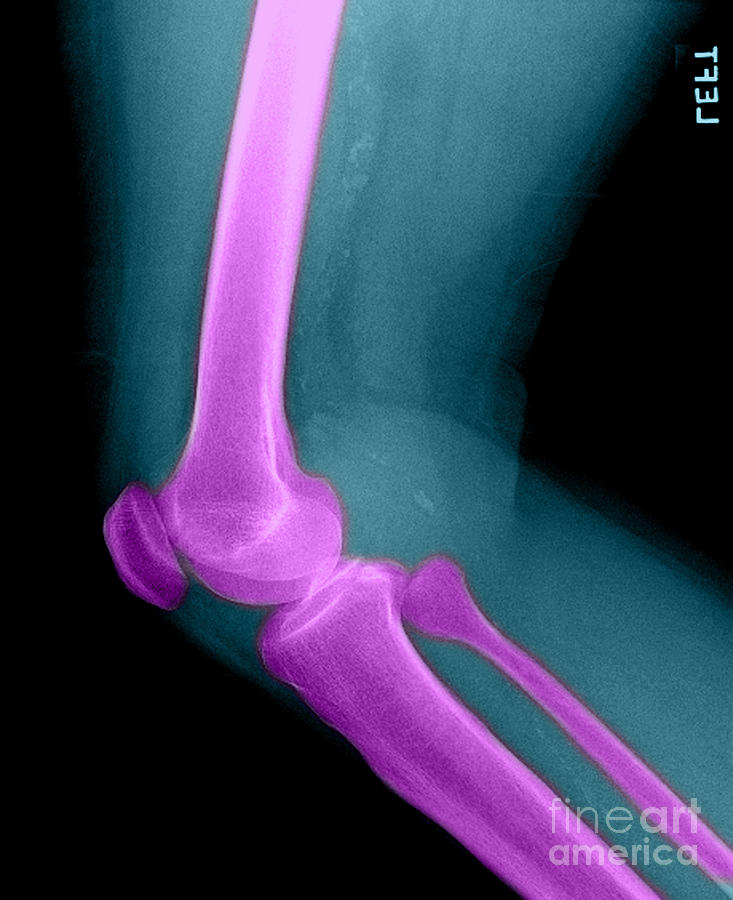 Bone Photograph - Lateral X-ray Of The Knee #1 by Medical Body Scans