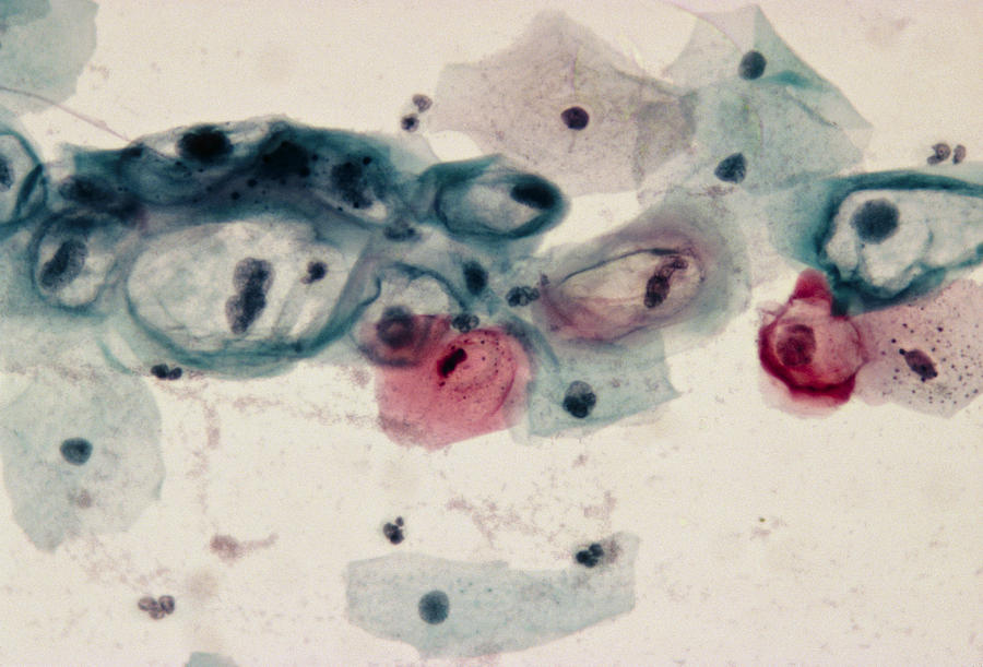 Cervical Photograph - Lm Of Cervical Smear Revealing Hpv Infection #1 by Dr. E. Walker