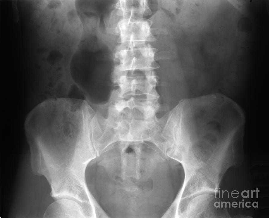 Lumbar X-ray #1 Photograph by Ted Kinsman