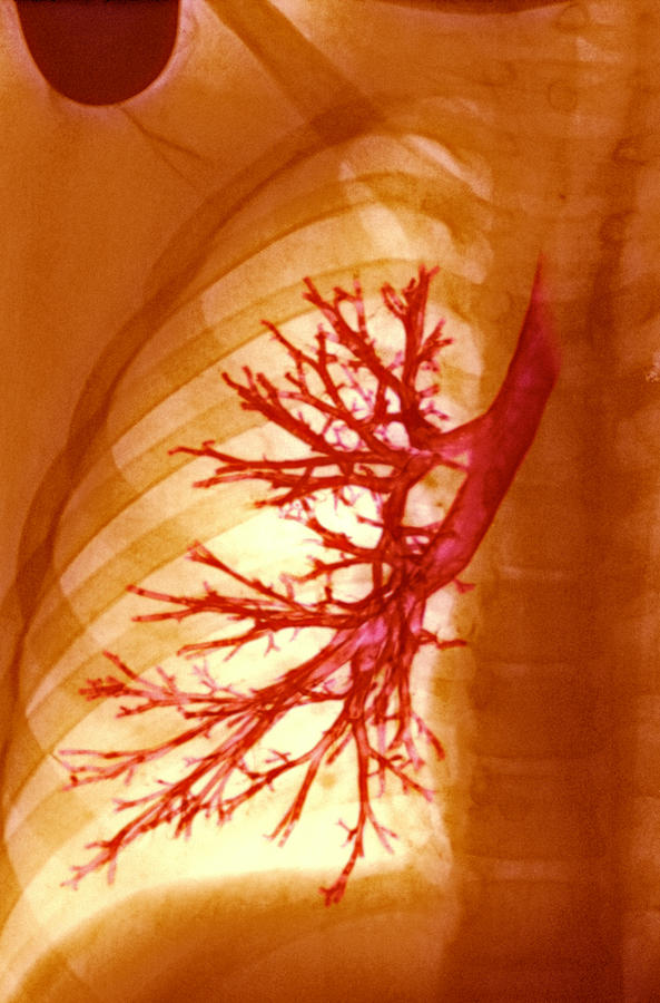 Lung Photograph - Lung Bronchioles, X-ray #1 by Cnri