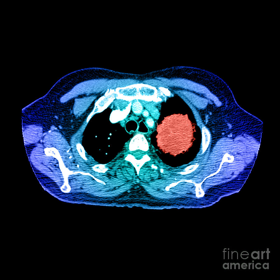 Lung Cancer #1 Photograph by Medical Body Scans