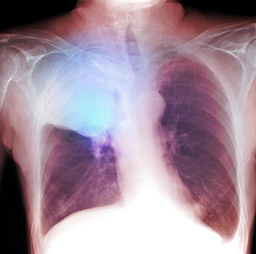 Disease Photograph - Lung Cancer, X-ray #1 by Du Cane Medical Imaging Ltd