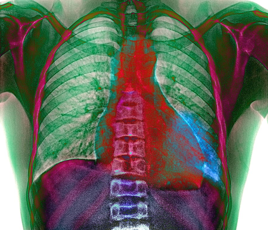 Lung Infection Photograph by Du Cane Medical Imaging Ltd | Fine Art America