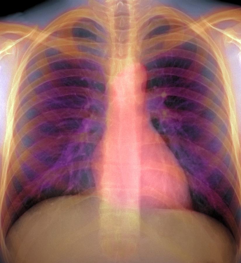 Lungs And Heart, X-ray Photograph By Du Cane Medical Imaging Ltd - Pixels