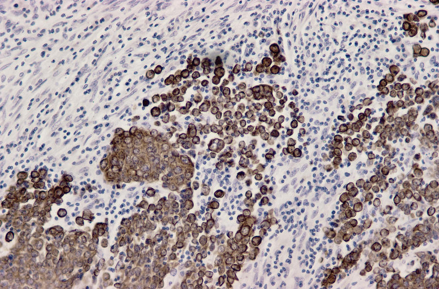 Lymph Node Cancer, Light Micrograph Photograph by Dr. E. Walker - Fine ...