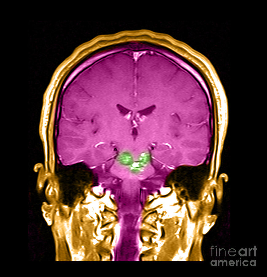 Mri Brainstem Cavernous Malformations #1 Photograph by Medical Body Scans