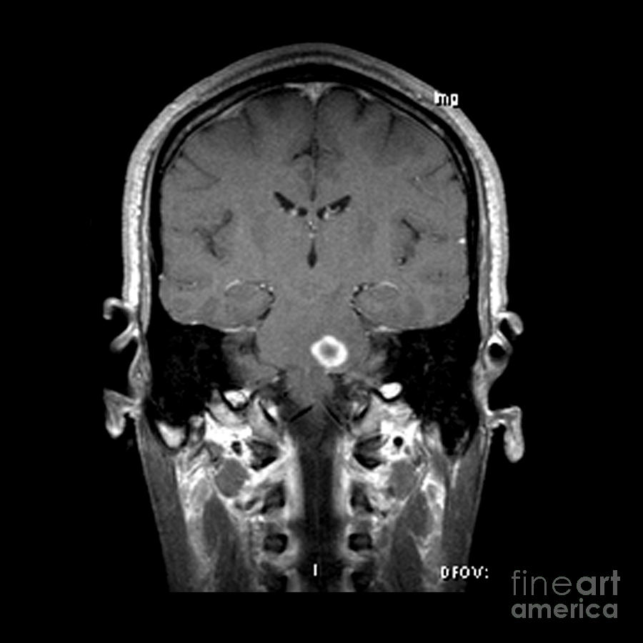 Mri Of Acute Ms #1 Photograph by Medical Body Scans
