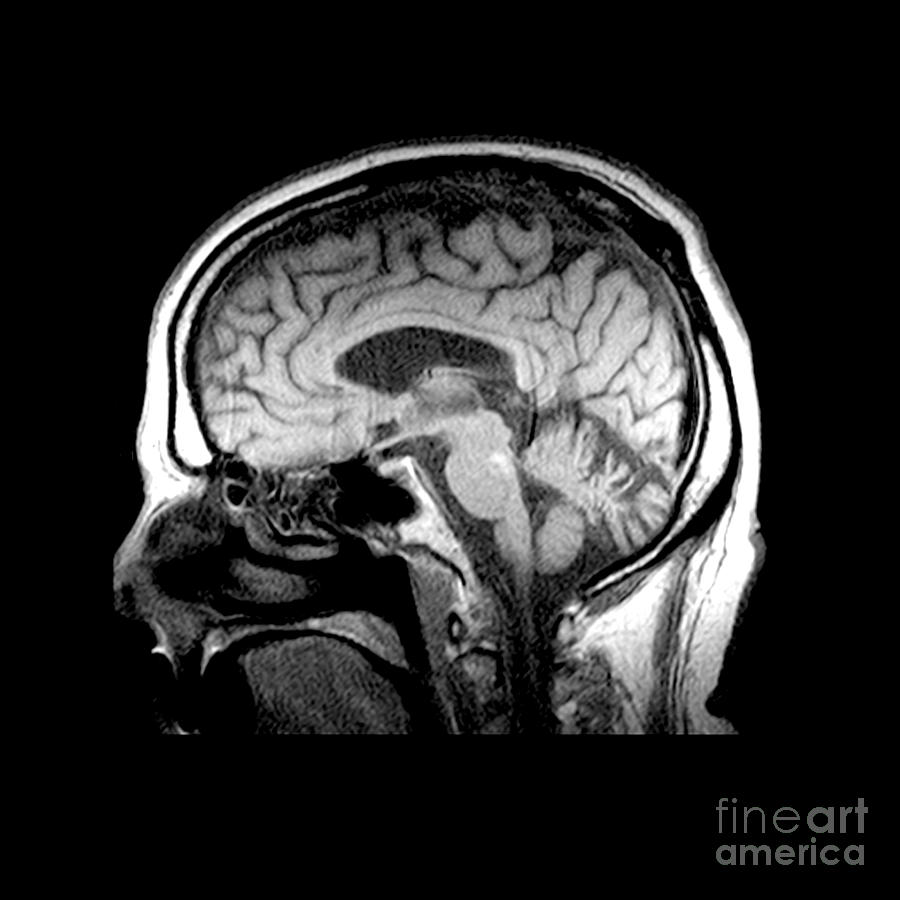 Mri Of Alcoholism Related Vermian Photograph by Medical Body Scans
