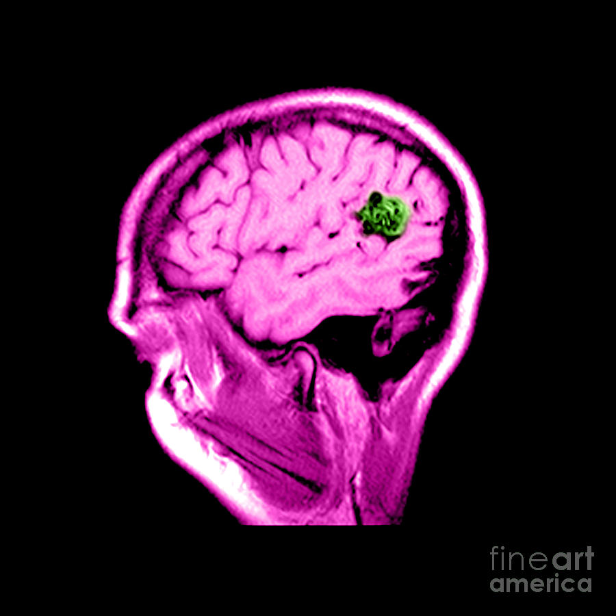 Mri Of Brain Avm #1 Photograph by Medical Body Scans
