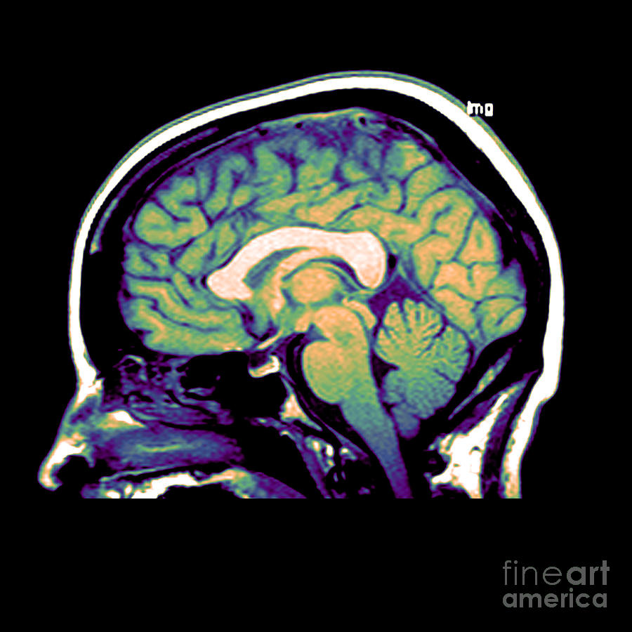 Mri Of Brain #1 Photograph by Medical Body Scans