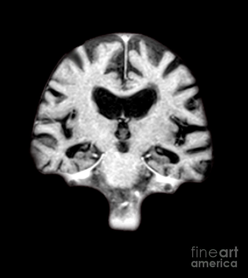 Magnetic Resonance Imaging Photograph - Mri Of Brain With Alzheimers Disease #1 by Medical Body Scans