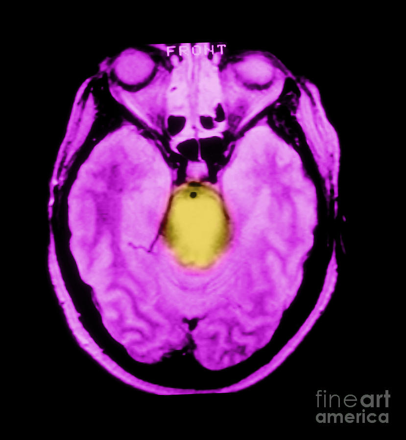 Mri Of Brainstem Glioma #1 Photograph by Medical Body Scans