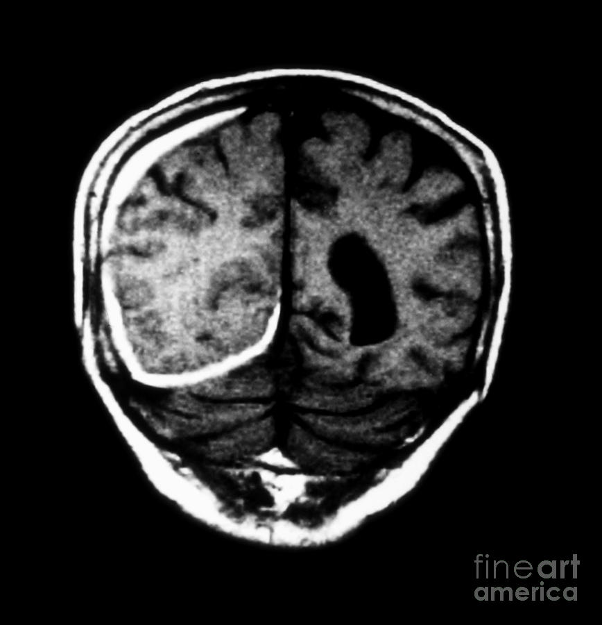 Mri Of Head Trauma #1 Photograph by Medical Body Scans