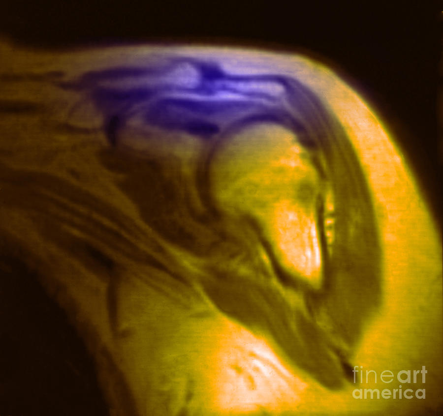 Mri Of Shoulder With Impingement #1 Photograph by Science Source