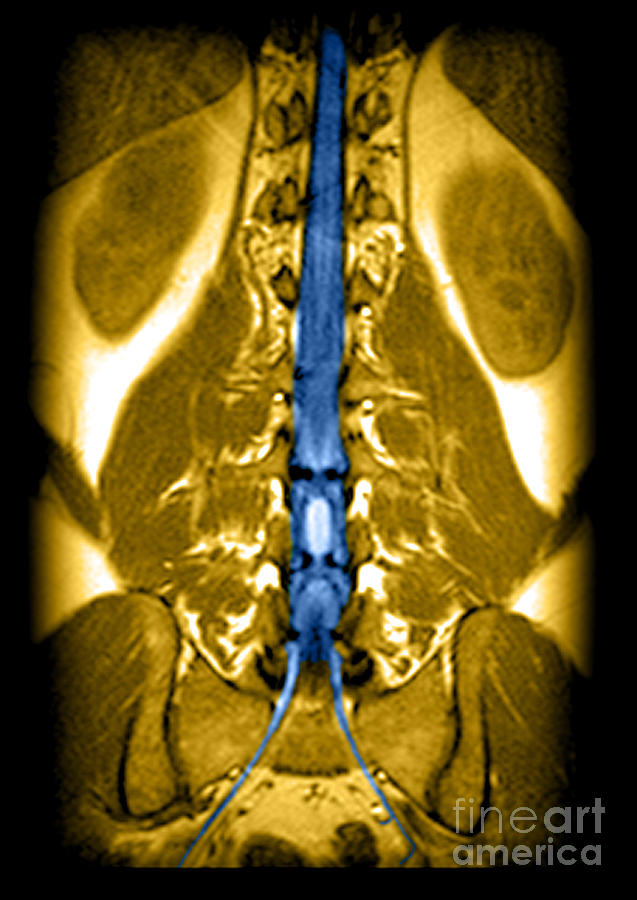 Mri Of Spinal Cord And Nerve Roots #1 Photograph by Medical Body Scans