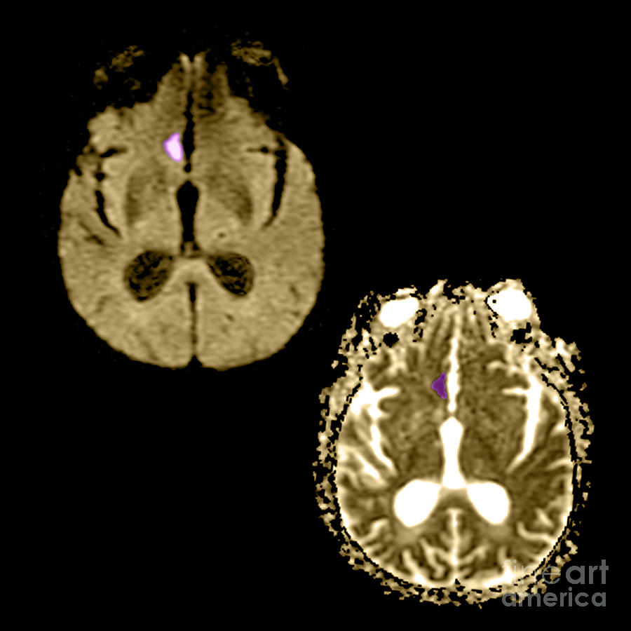 Mri Of Stroke #1 Photograph by Medical Body Scans