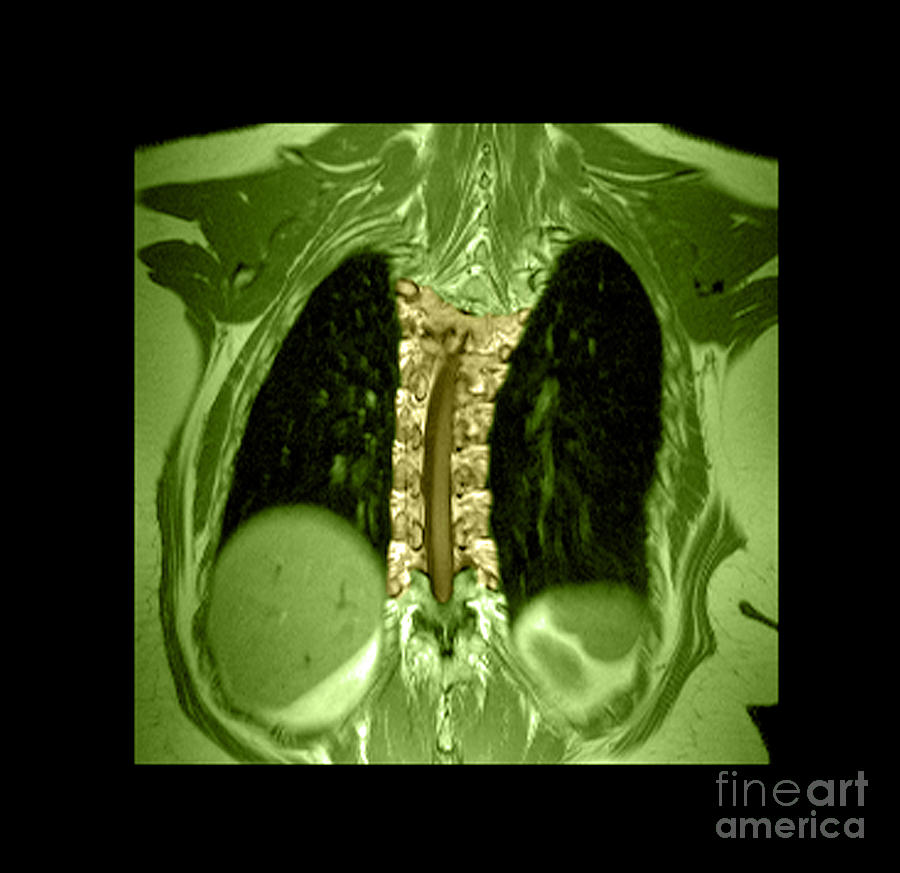 Mri Of Thoracic Scoliosis #1 Photograph by Medical Body Scans