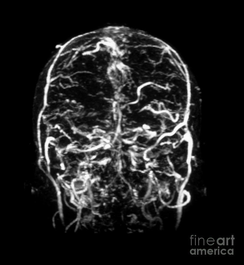Mri Of Venogram Of Dural Sinus #1 Photograph by Medical Body Scans