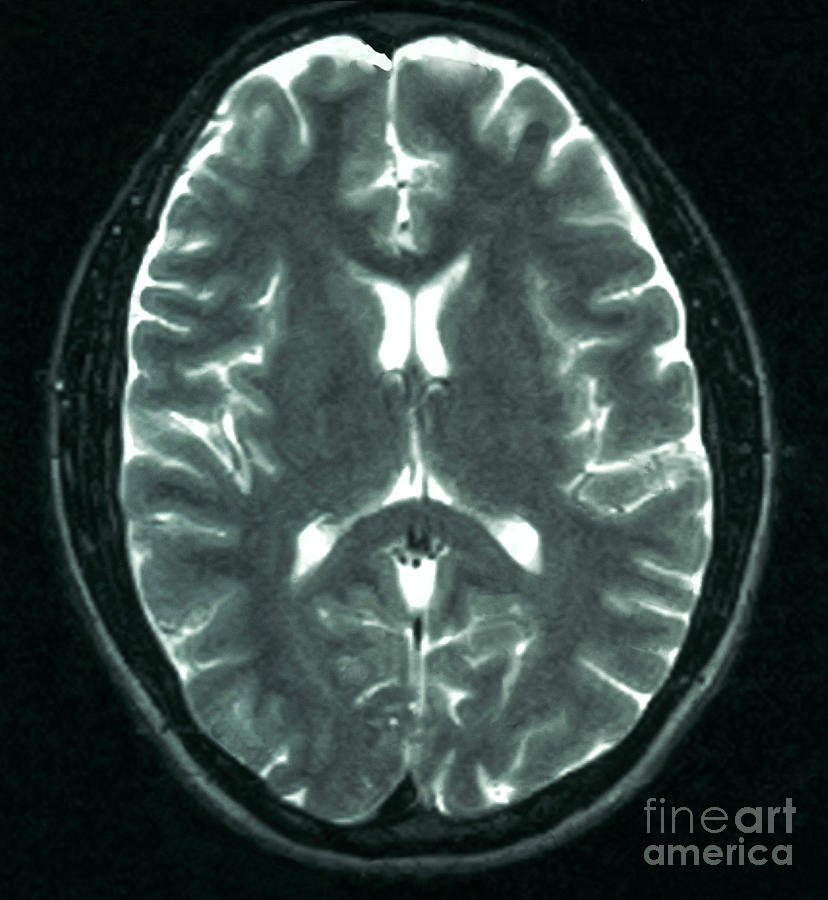Mri Showing Arachnoid Cyst #1 Photograph by Science Source