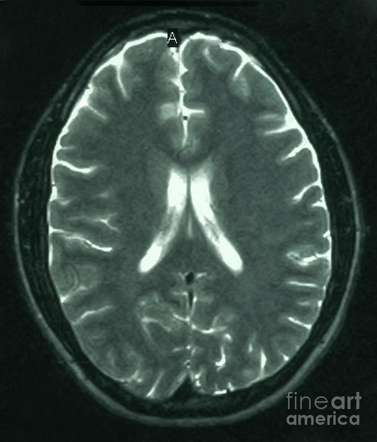 Mri Showing Normal Brain #1 Photograph by Science Source