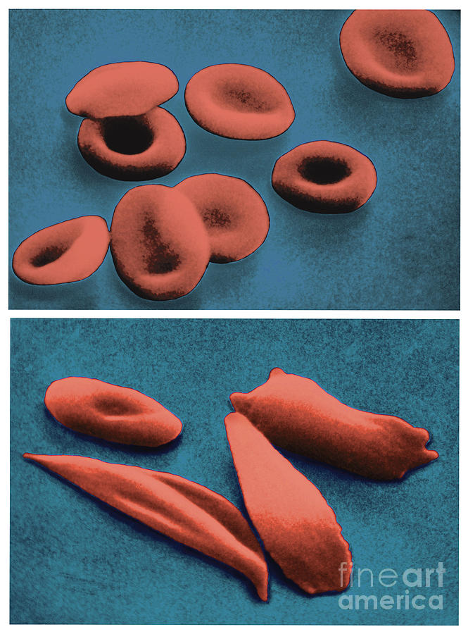 Normal And Sickle Red Blood Cells #1 Photograph by Omikron