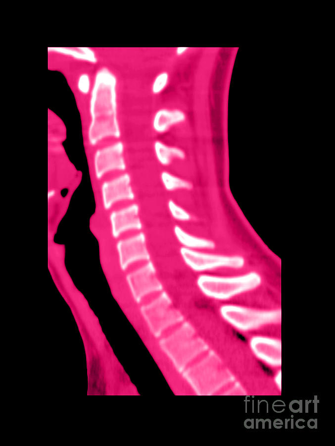 Normal Cervical Spine #4 Photograph by Medical Body Scans