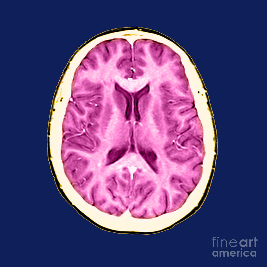 Normal Cross Sectional Mri Of The Brain #1 Photograph by Medical Body Scans