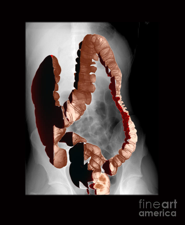 Barium Enema Photograph - Normal Double Contrast Barium Enema #1 by Medical Body Scans