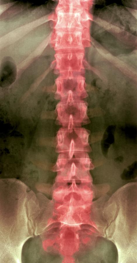 normal spine xray