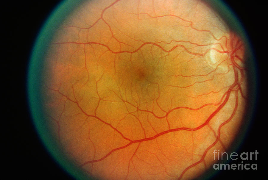 Normal Retina #1 Photograph by Science Source