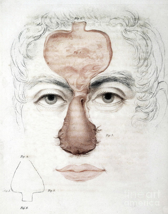Nose Reconstruction, 1815 Medical Text #2 Photograph by Science Source