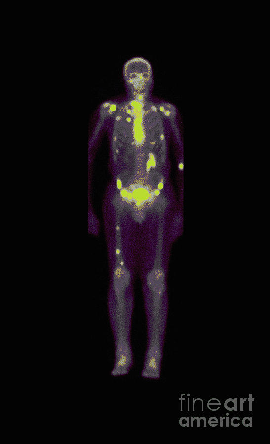 Nuclear Medicine Bone Scan #1 Photograph by Medical Body Scans