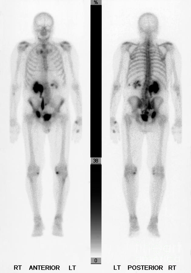 Skeleton Photograph - Nuclear Medicine #1 by Ted Kinsman