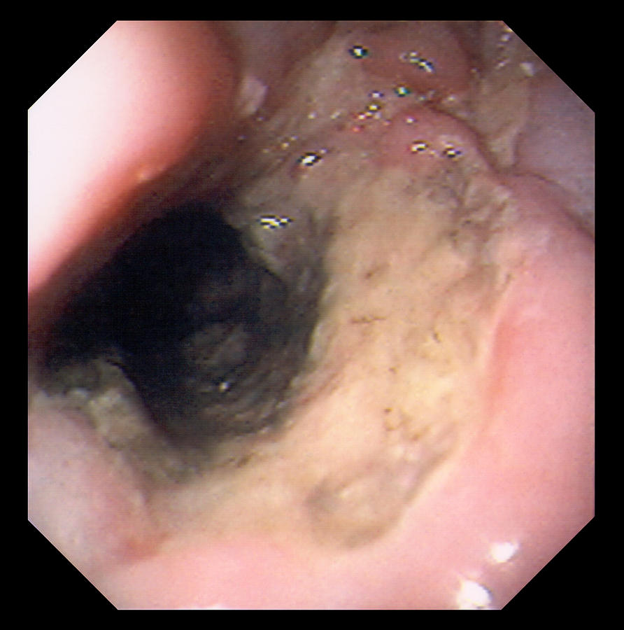 Oesophagus Ulcer Photograph - Oesophagus Ulcer #1 by David M. Martin, Md