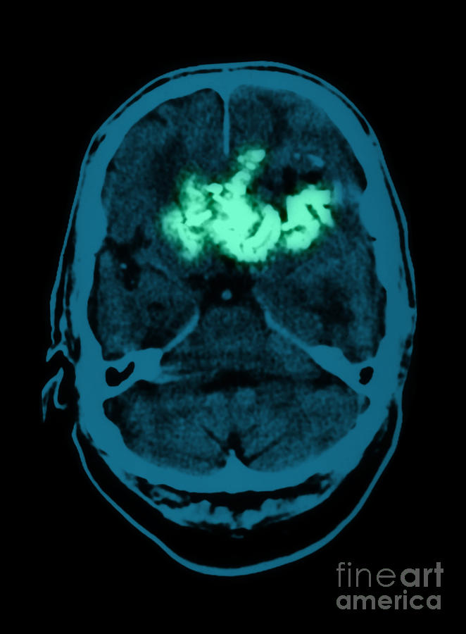 Oligodendroglioma #1 Photograph by Medical Body Scans